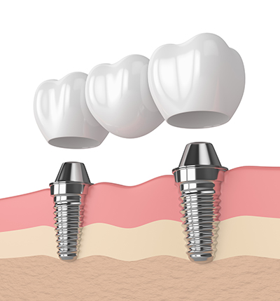 Oyster Point Dental - Dental Bridge