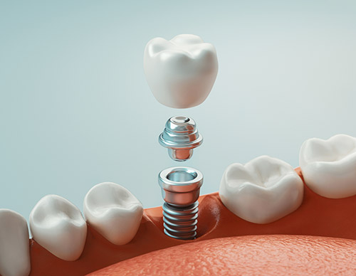 Oyster Point Dental - Dental Implants