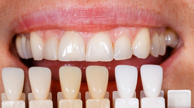 Oyster Point Dental - Dental Veneers