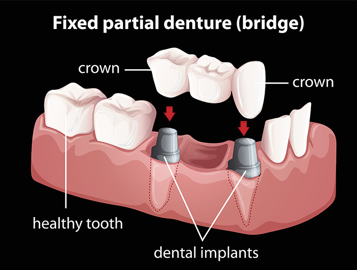 Oyster Point Dentistry - Dental Bridges, Newport, News, VA