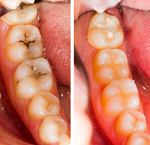 Oyster Point Dental - Invisible Filling