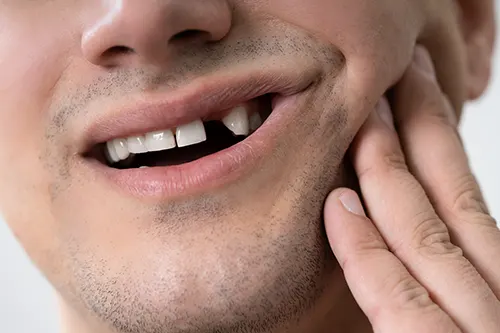 Oyster Point Dental - What Happens If You Don’t Replace a Missing Tooth?